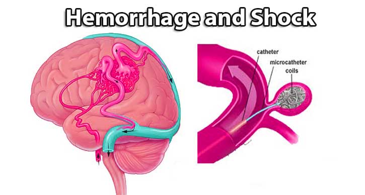 what is hemorrhagic shock